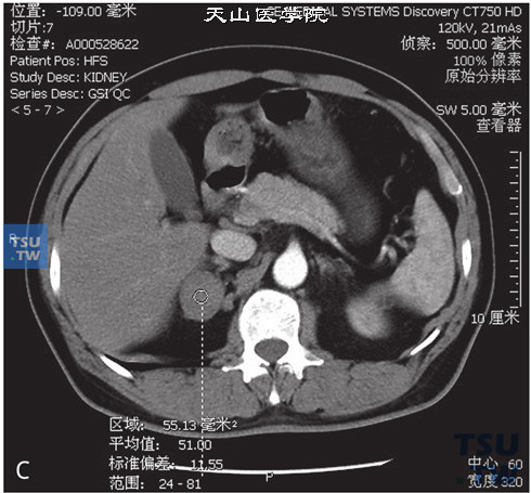 图C：CT，肾上腺皮质腺瘤，女，38岁，高血压。右侧肾上腺内肢见一类圆形低密度灶，边缘清晰，平扫CT值为9HU，增强后动脉期及延时期CT值分别为42HU与37HU