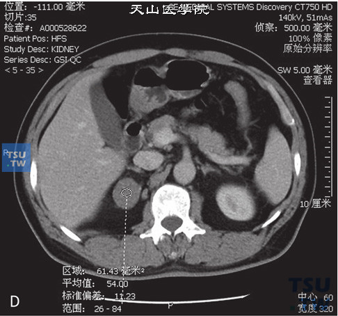 图D：CT，肾上腺皮质腺瘤，女，38岁，高血压。右侧肾上腺内肢见一类圆形低密度灶，边缘清晰，平扫CT值为9HU，增强后动脉期及延时期CT值分别为42HU与37HU