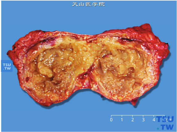 肾上腺皮质腺瘤（Cushing综合征）（大体切面）。肿瘤颜色可因充血、出血、瘤体内脂肪和脂褐素含量不同而变化