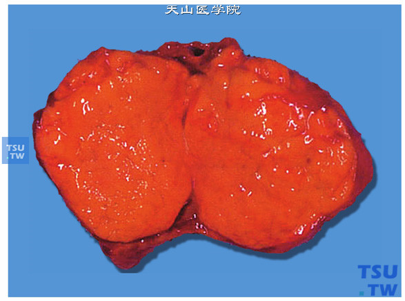 肾上腺皮质腺瘤（醛固酮增多症）（大体切面）。肿瘤呈橘黄色