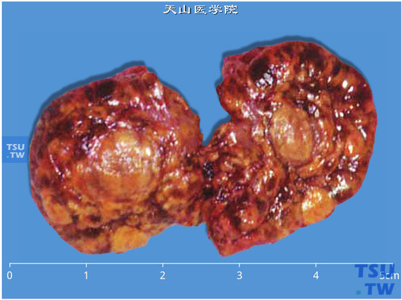 伴女性化的肾上腺皮质腺瘤（大体切面），瘤体大，颜色多样，常有坏死