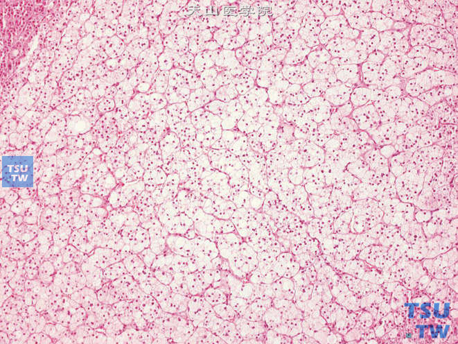 肾上腺皮质腺瘤，细胞排列成腺泡状、巢状或短条索状，胞质内可见大量空泡