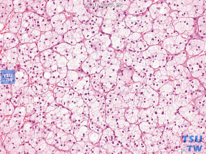 肾上腺皮质腺瘤，间质为纤细的纤维血管分隔