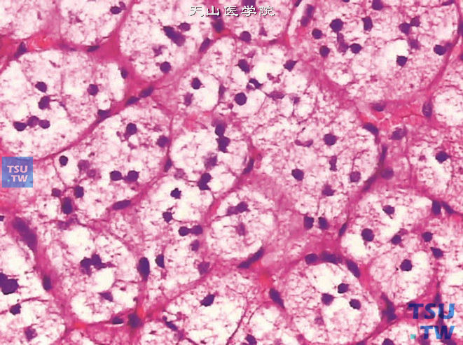 肾上腺皮质腺瘤，上图高倍，瘤细胞胞质中脂类丰富，呈空泡状