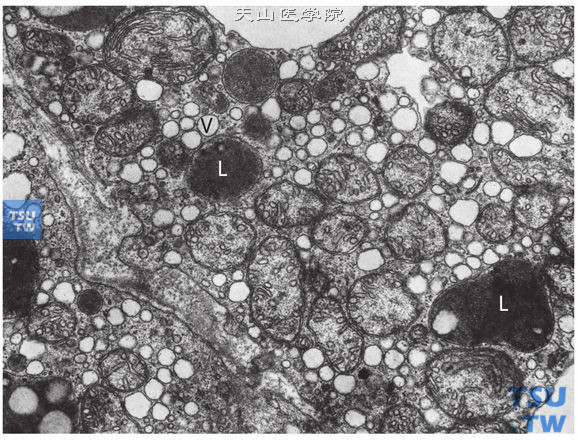 肾上腺皮质腺瘤，电镜下，细胞浆内有大量的滑面内质网、脂类物质（L）和空泡（V）。线粒体呈管状、嵴状或泡状