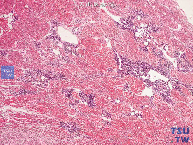 功能性色素性肾上腺皮质腺瘤，结构类似于其他腺瘤