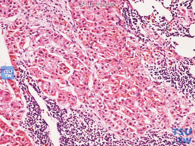 功能性色素性肾上腺皮质腺瘤，上图高倍，示细胞中的色素颗粒