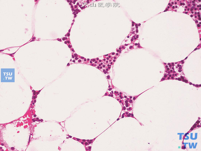肾上腺皮质腺瘤，伴髓脂肪瘤样化生，示髓脂肪瘤样化生的髓细胞成分，可见细胞呈多角形，胞质粉染，核深染，圆形，居中