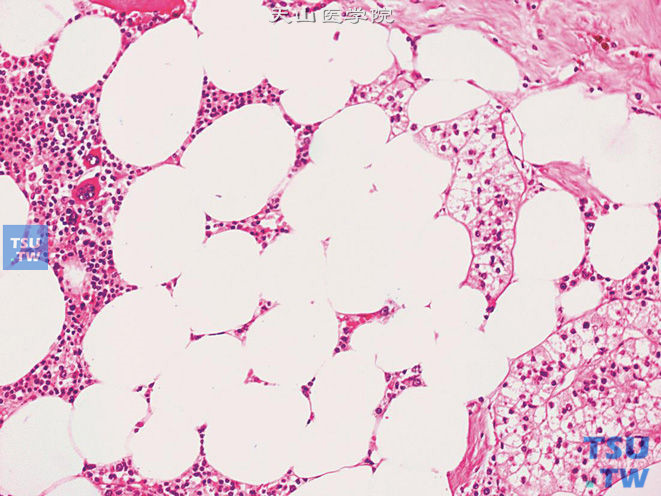 肾上腺皮质腺瘤，伴髓脂肪瘤样化生。示髓细胞成分中可见巨核细胞