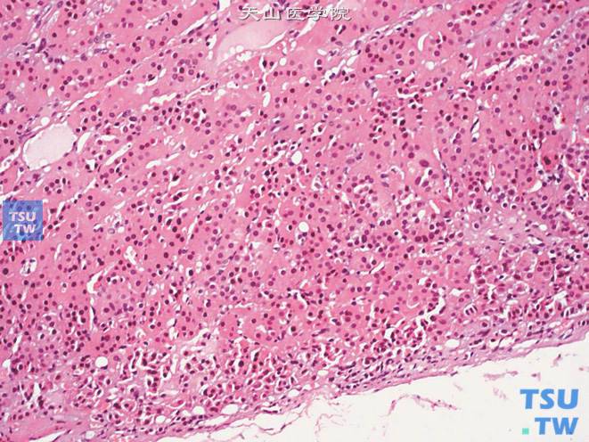 肾上腺皮质嗜酸细胞腺瘤，可见包膜