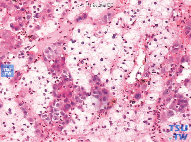 肾上腺皮质腺瘤恶变，示良性腺瘤背景中可见异型性明显的细胞