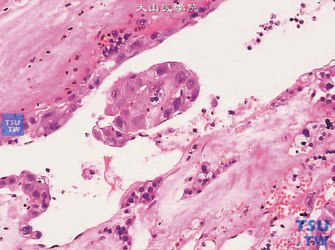 肾上腺皮质腺瘤恶变，示恶性细胞团，周围可见良性肾上腺皮质细胞