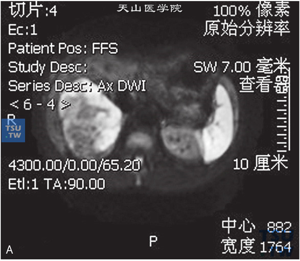 图A：CT，肾上腺皮质癌，男，58岁，腹部包块，高血压。右肾上腺区间T1WI等及高信号T1WI等及低信号灶，边缘清晰，DWI呈不均匀高信号。增强后实性成分明显强化a