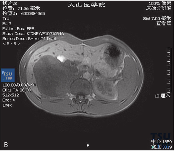 图B：CT，肾上腺皮质癌，男，58岁，腹部包块，高血压。右肾上腺区间T1WI等及高信号T1WI等及低信号灶，边缘清晰，DWI呈不均匀高信号。增强后实性成分明显强化a