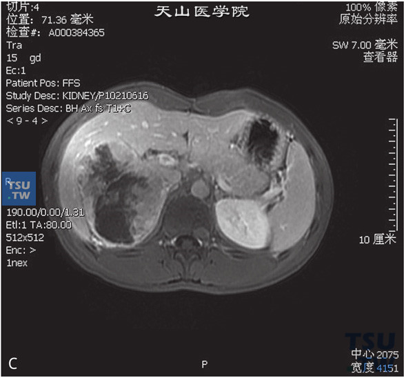 图C：CT，肾上腺皮质癌，男，58岁，腹部包块，高血压。右肾上腺区间T1WI等及高信号T1WI等及低信号灶，边缘清晰，DWI呈不均匀高信号。增强后实性成分明显强化a