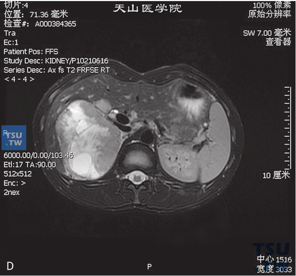 图D：CT，肾上腺皮质癌，男，58岁，腹部包块，高血压。右肾上腺区间T1WI等及高信号T1WI等及低信号灶，边缘清晰，DWI呈不均匀高信号。增强后实性成分明显强化a