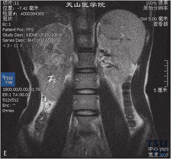 图E：CT，肾上腺皮质癌，男，58岁，腹部包块，高血压。右肾上腺区间T1WI等及高信号T1WI等及低信号灶，边缘清晰，DWI呈不均匀高信号。增强后实性成分明显强化a