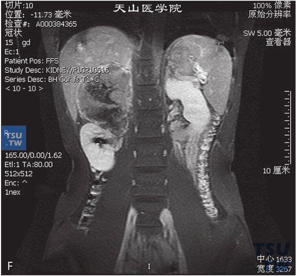 图F：CT，肾上腺皮质癌，男，58岁，腹部包块，高血压。右肾上腺区间T1WI等及高信号T1WI等及低信号灶，边缘清晰，DWI呈不均匀高信号。增强后实性成分明显强化a