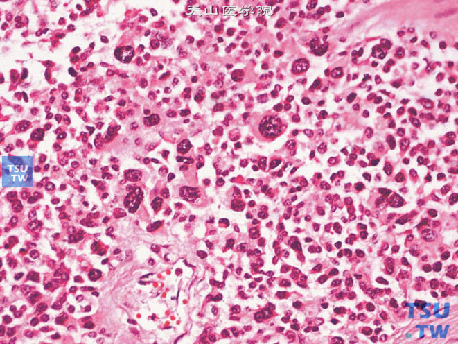 肾上腺皮质癌，示胞质嗜酸的瘤巨细胞、奇异核及多核细胞