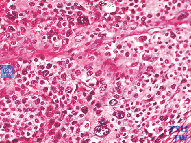 肾上腺皮质癌，示瘤巨细胞与奇异核细胞