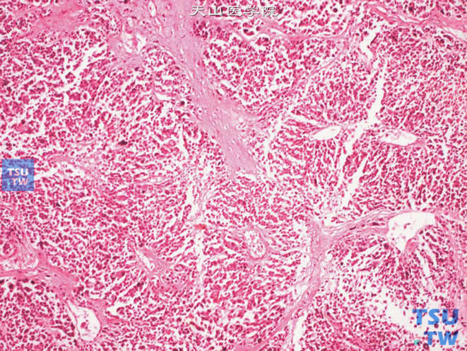 肾上腺皮质癌，示纤维性间质