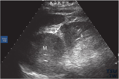 嗜铬细胞瘤声像图特点：肿物大多为圆形或椭圆形，形态规则，边缘整齐，界限清晰；内部回声均质，中低回声常见。此病例肿物较大压迫肾脏，将肾脏向后下方推移，肾脏受压变形（M：代表瘤体）