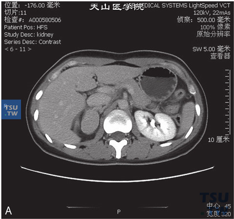 图A：CT，肾上腺嗜铬细胞瘤，男，48岁，高血压。右侧肾上腺见一软组织密度肿物，边缘清晰，增强后明显强化