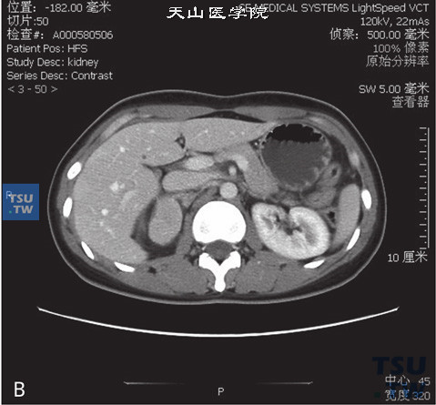 图B：CT，肾上腺嗜铬细胞瘤，男，48岁，高血压。右侧肾上腺见一软组织密度肿物，边缘清晰，增强后明显强化