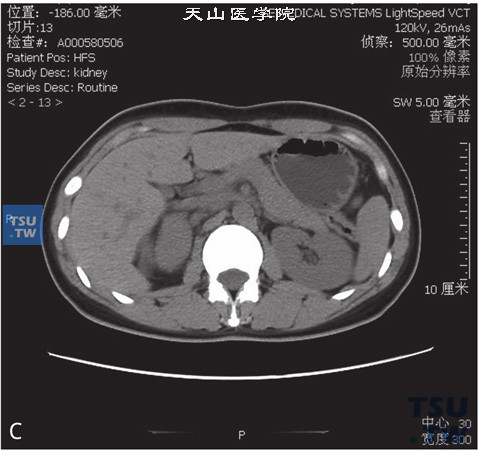 图C：CT，肾上腺嗜铬细胞瘤，男，48岁，高血压。右侧肾上腺见一软组织密度肿物，边缘清晰，增强后明显强化