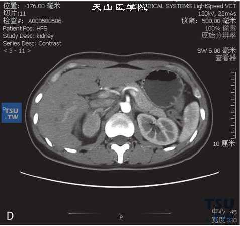 图D：CT，肾上腺嗜铬细胞瘤，男，48岁，高血压。右侧肾上腺见一软组织密度肿物，边缘清晰，增强后明显强化
