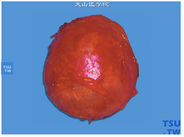 肾上腺嗜铬细胞瘤（大体），肿瘤呈单中心性，球形或卵圆形，与周围分界清，外有包膜