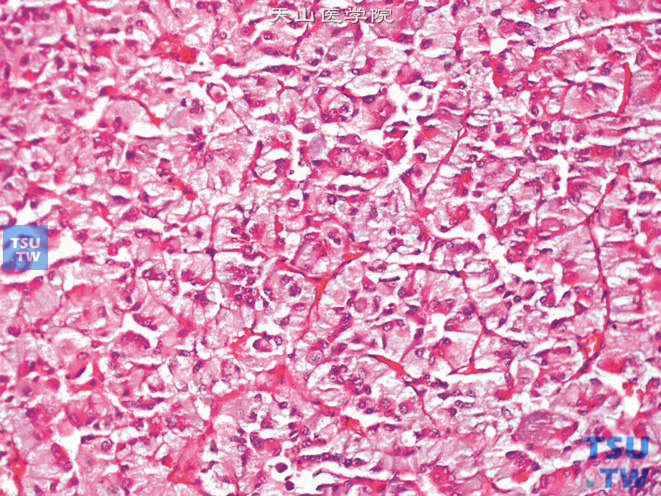 肾上腺嗜铬细胞瘤，上图高倍，示瘤细胞较大，胞质颗粒状，嗜碱性或嗜双染。核仁明显