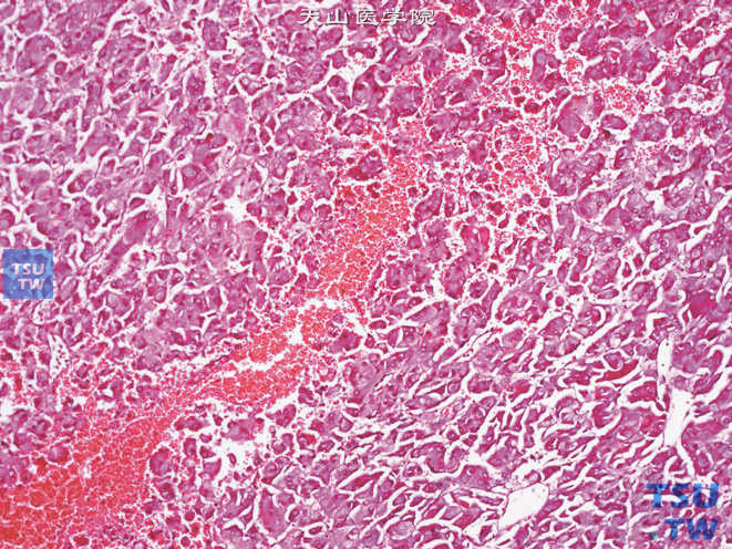 肾上腺嗜铬细胞瘤，细胞排列成梁状结构，伴出血