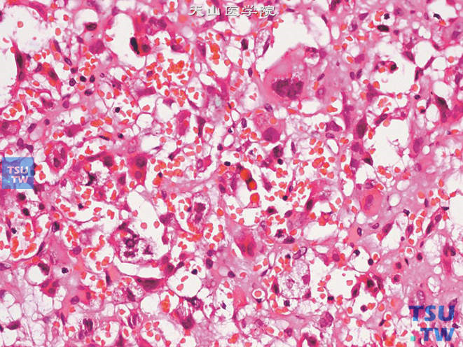肾上腺混合性嗜铬细胞瘤，示嗜铬细胞瘤瘤细胞内外的球形透明样小体
