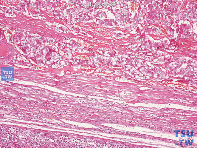 肾上腺嗜铬细胞瘤，肿瘤与肾上腺组织间可见假包膜