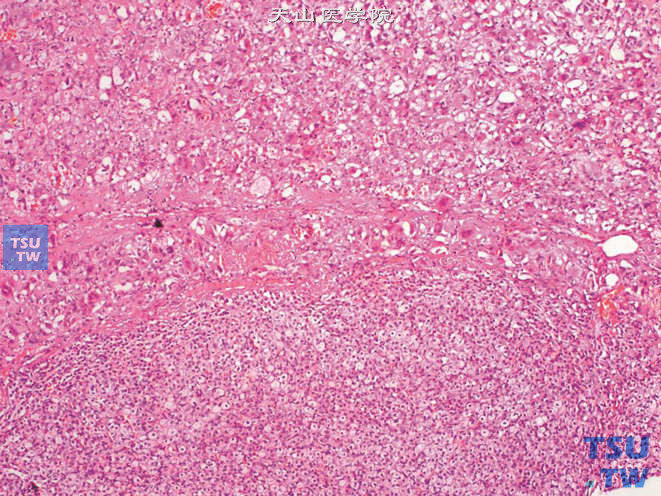 肾上腺混合性嗜铬细胞瘤，含肾上腺皮质成分（下方）