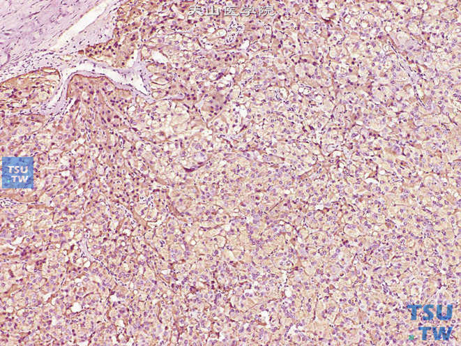 肾上腺嗜铬细胞瘤，免疫组化：CgA（+）