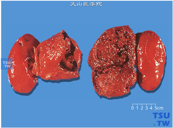 肾上腺恶性嗜铬细胞瘤（双侧）（大体）。瘤体较大，常坚韧有弹性及光泽，可出现明显的囊性变