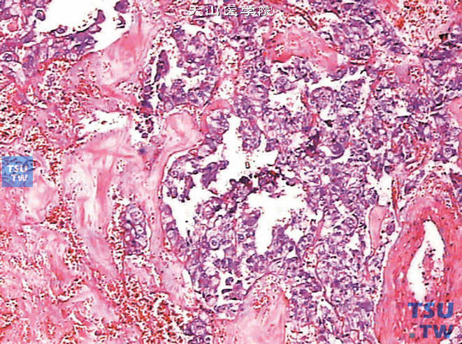 恶性嗜铬细胞瘤，示细胞异型性及坏死