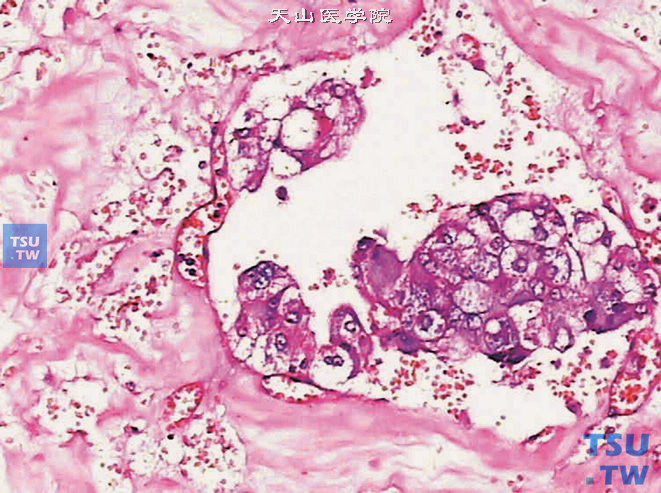 恶性嗜铬细胞瘤，上图高倍，示细胞异型性、坏死及显著的核仁