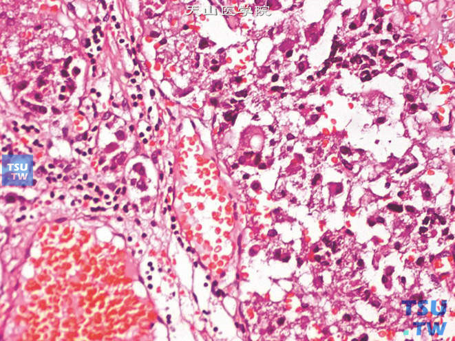恶性嗜铬细胞瘤，示细胞异型及核分裂象（图中央）