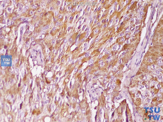 恶性嗜铬细胞瘤，CgA（+）