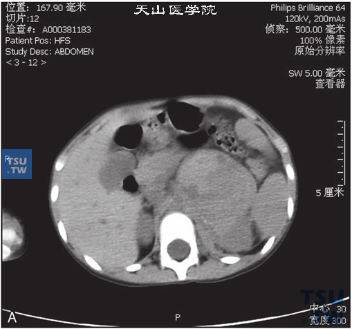 图A：CT，肾上腺神经母细胞瘤，女，3岁，腹部包块。左侧肾上腺区见软组织密度肿块，内部密度不均匀，增强后可见不均匀强化，内部可见多发坏死灶