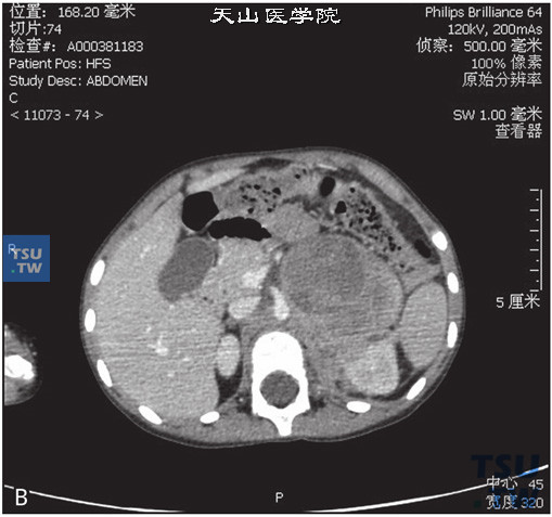 图B：CT，肾上腺神经母细胞瘤，女，3岁，腹部包块。左侧肾上腺区见软组织密度肿块，内部密度不均匀，增强后可见不均匀强化，内部可见多发坏死灶