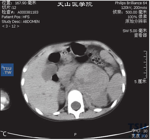 图C：CT，肾上腺神经母细胞瘤，女，3岁，腹部包块。左侧肾上腺区见软组织密度肿块，内部密度不均匀，增强后可见不均匀强化，内部可见多发坏死灶