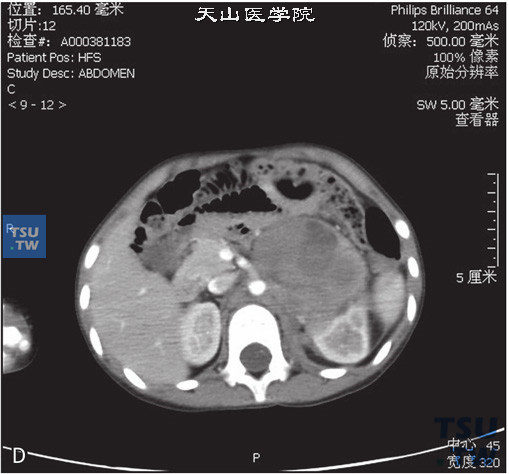 图D：CT，肾上腺神经母细胞瘤，女，3岁，腹部包块。左侧肾上腺区见软组织密度肿块，内部密度不均匀，增强后可见不均匀强化，内部可见多发坏死灶