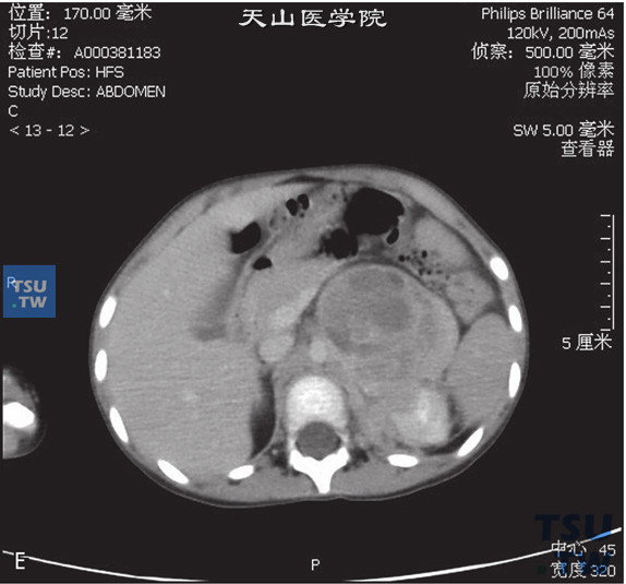 图E：CT，肾上腺神经母细胞瘤，女，3岁，腹部包块。左侧肾上腺区见软组织密度肿块，内部密度不均匀，增强后可见不均匀强化，内部可见多发坏死灶