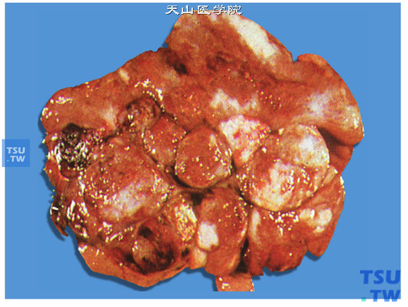 肾上腺髓质肿瘤：神经母细胞瘤病理图谱