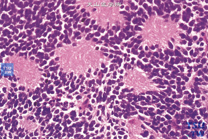 肾上腺髓质神经母细胞瘤，瘤细胞形成菊形团样结构，中央为纤细的神经纤维样结构