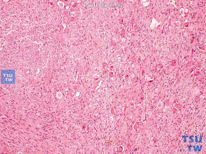肾上腺节细胞神经瘤，肿瘤由神经节细胞、神经鞘细胞和神经纤维构成